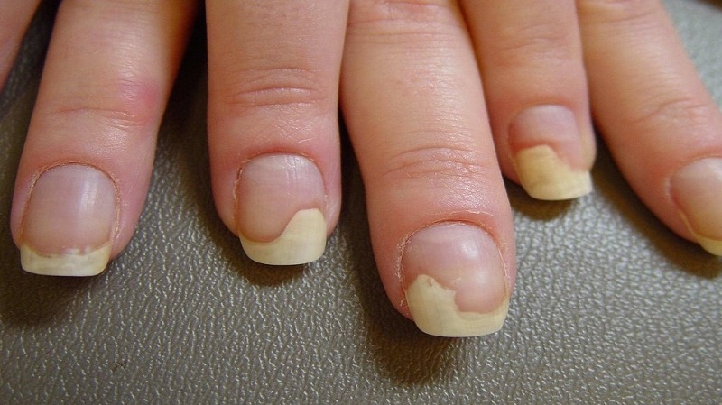 Лечение грибка ногтей рук народными средствами.