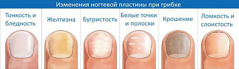Как поставить диагноз грибка ногтей по внешнему виду.