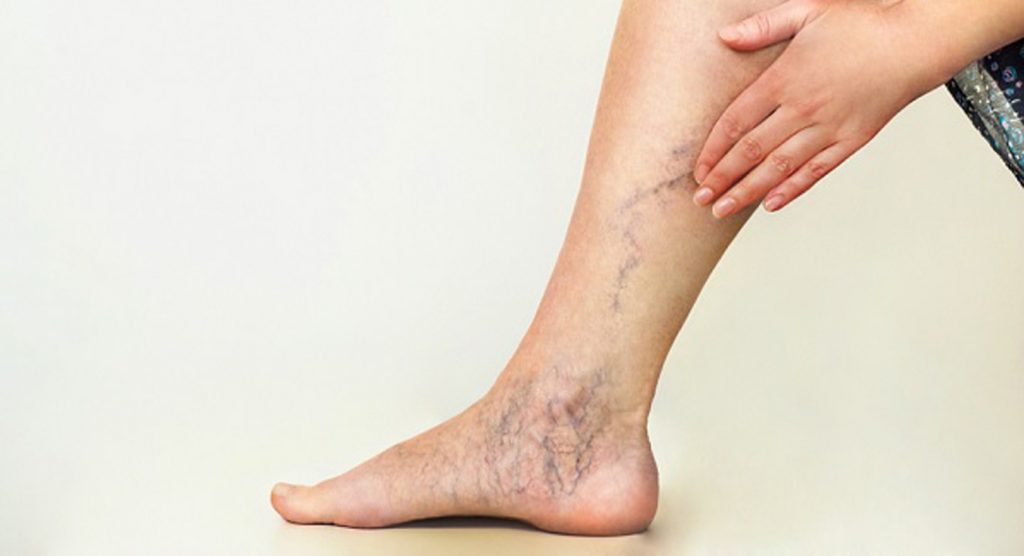 Лечение варикозного расширения вен на ногах.