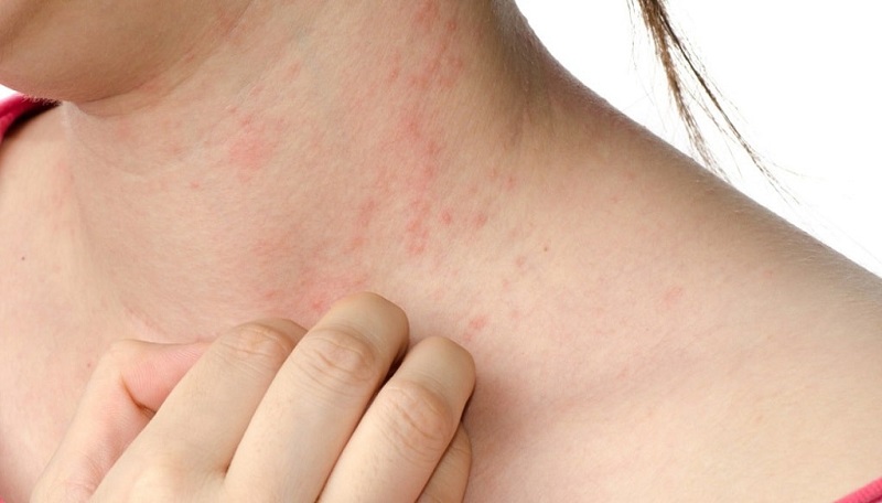 Аллергия на коже шеи.